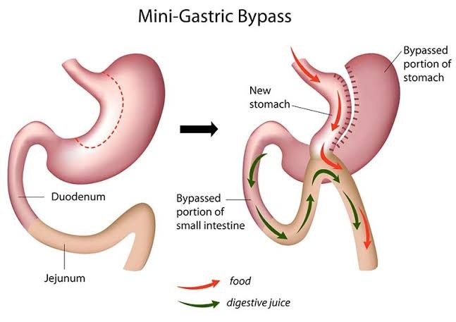Mini / OAGB gastric bypass diagram