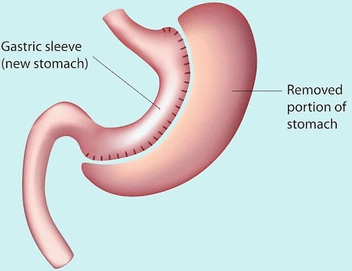 Sleeve gastrectomy — the stomach reshaped into a slim sleeve